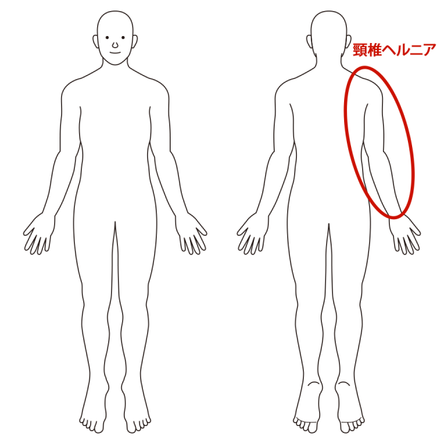 右肩から腕にかけて
